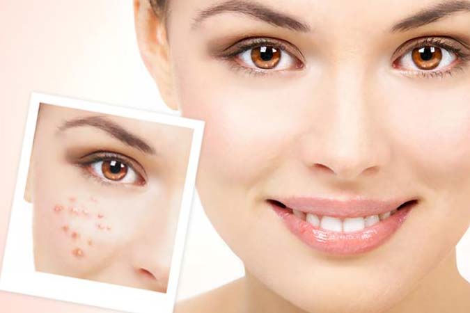 How should we prevent pimples on the face?