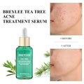Tea Tree Acne Treatment Serum