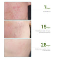 Acne Treatment Facial Toner